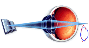 presbyopia2